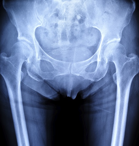X-ray image of human pelvis